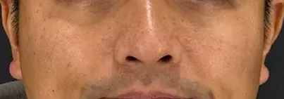 http://鼻横のほくろ除去施術後の男性の顔写真（正面）