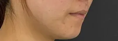 http://ニードル治療後の女性の横顔（右）