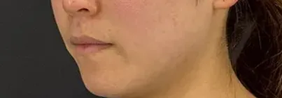 http://ニードル治療後の女性の横顔（左）