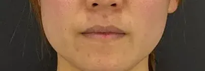 http://ニードル治療後の女性の顔（正面）