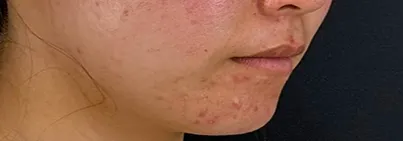 ニードル治療前の女性の横顔（右）