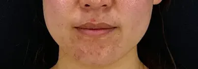ニードル治療前の女性の顔（正面）