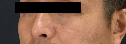 http://鼻横のほくろ除去施術後の男性の横顔写真