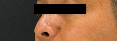 鼻横のほくろ除去施術前の男性の顔写真