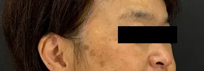 http://レーザー治療後にシミが改善した女性の横顔（右）の写真
