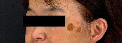 レーザー治療前の女性の横顔（左）の写真