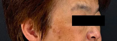 レーザー治療前の女性の横顔（右）の写真