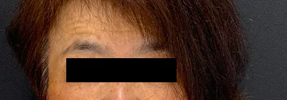 レーザー治療前の女性の顔（正面）の写真