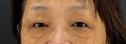 二重手術(全切開法)女性_施術前①