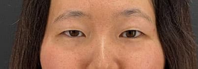 二重埋没法(4点留め)女性_施術前②