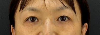 二重埋没法(4点留め)女性_施術前③