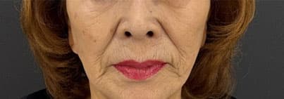 糸リフト12本(片側6本)女性_施術前 正面