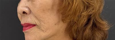 糸リフト12本(片側6本)女性_施術前 右